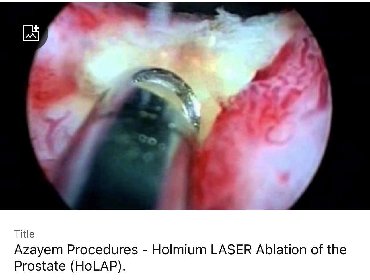 Holmium LASER Ablation of the Prostate (HoLAP)