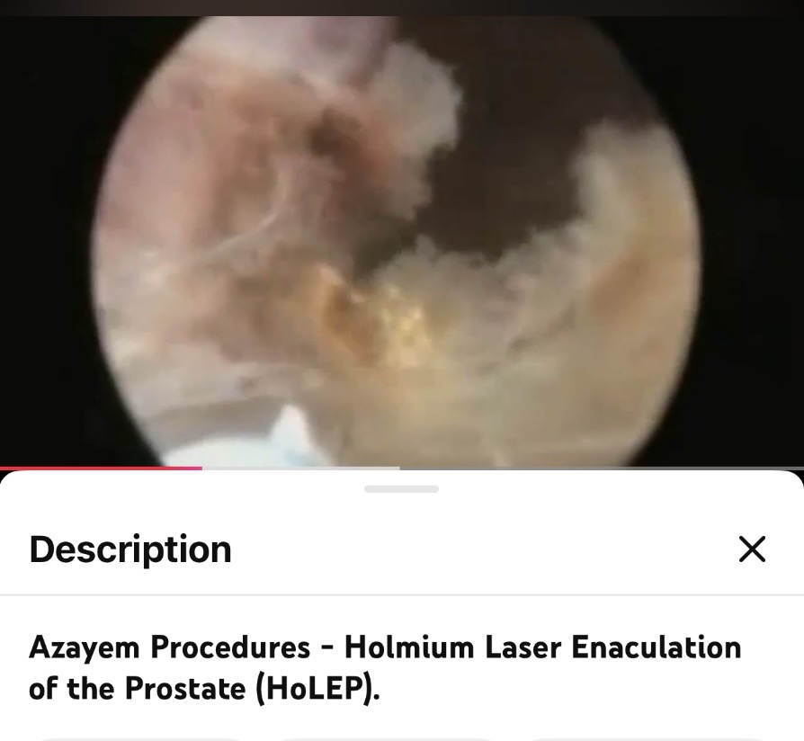 HoLEP