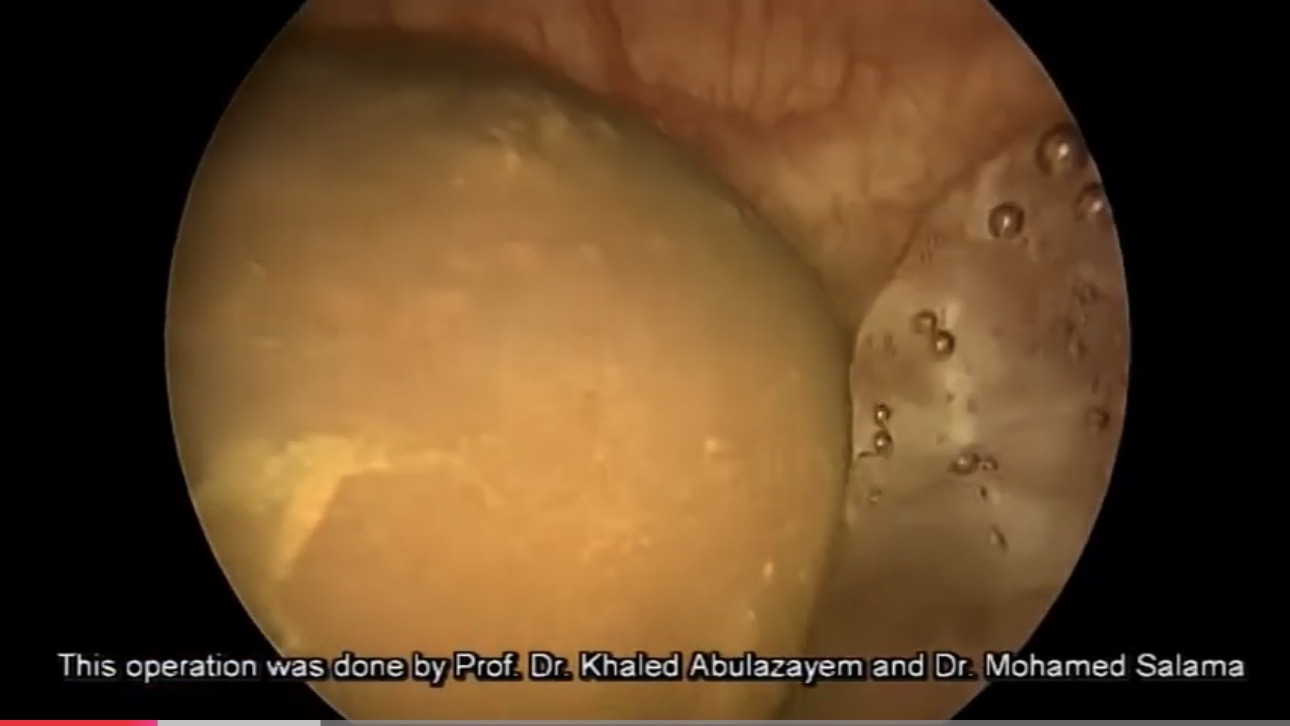 Laser bladder stone fragmentation and plasma vaporization of benign prostatic enlargement thumbnail