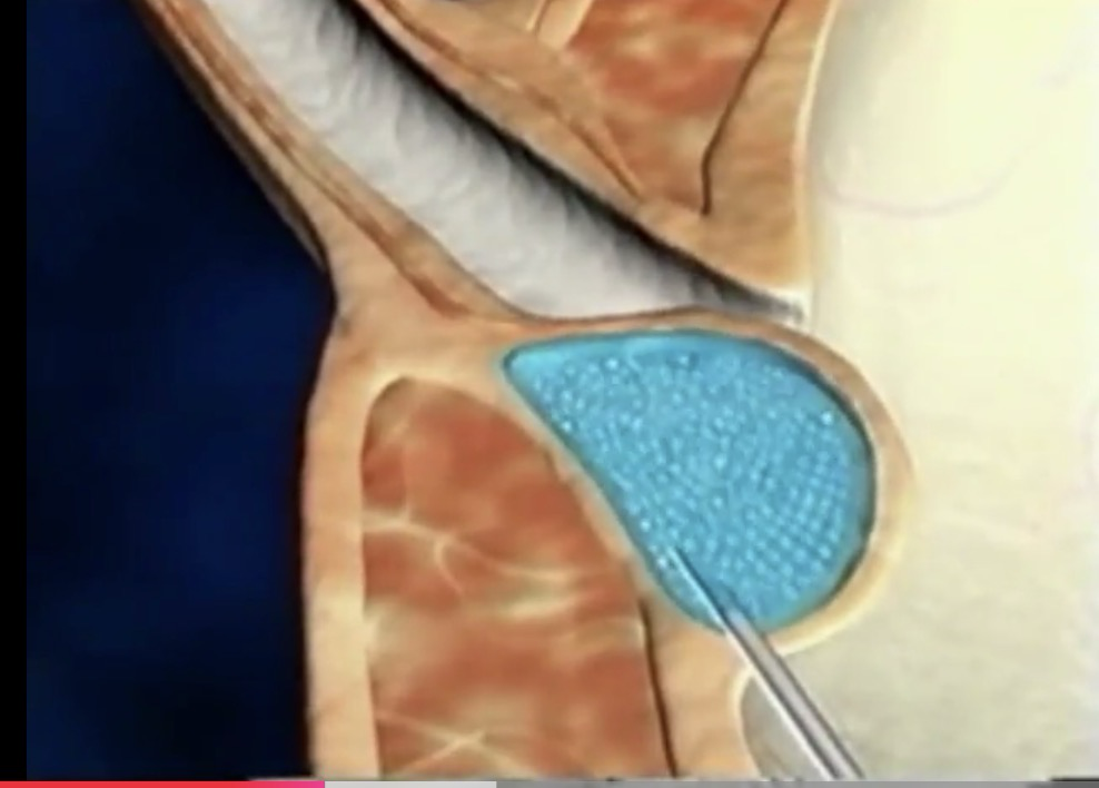 Endoscopic treatment of vesicoureteral reflux in children thumbnail