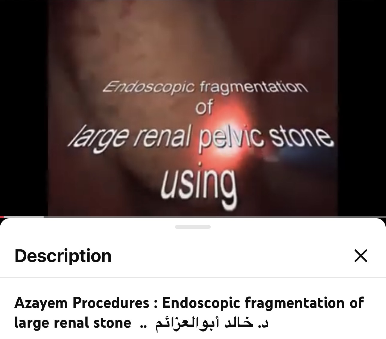 Endoscopic Fragmentation of a Large Renal Pelvic Stone